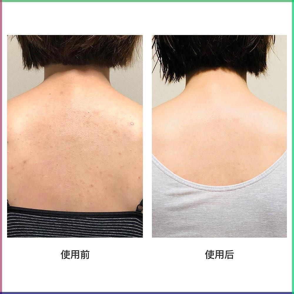 Deitanseki for Back acne 50g